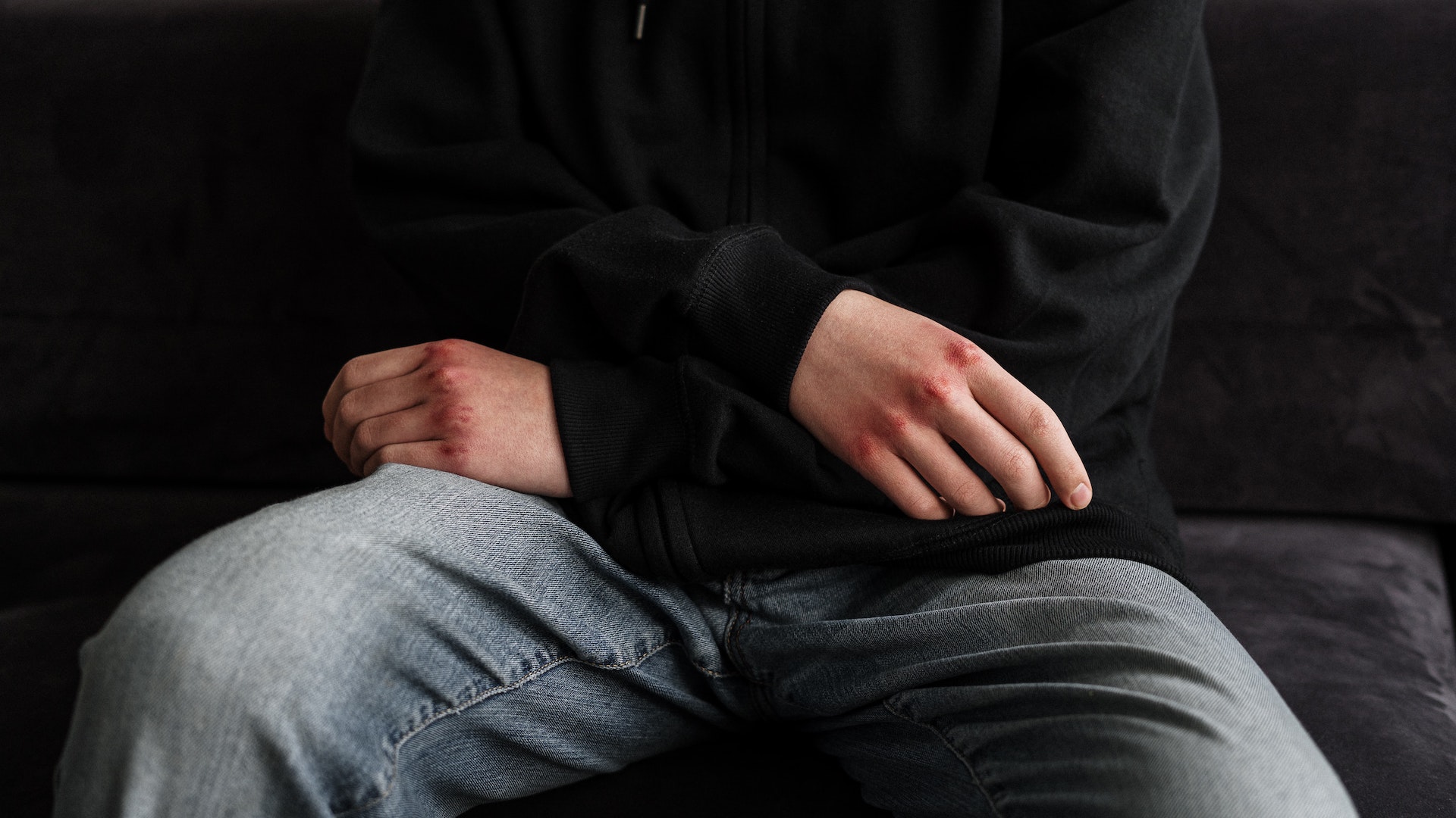 A man has red raw knuckles, suggesting violence or domestic abuse