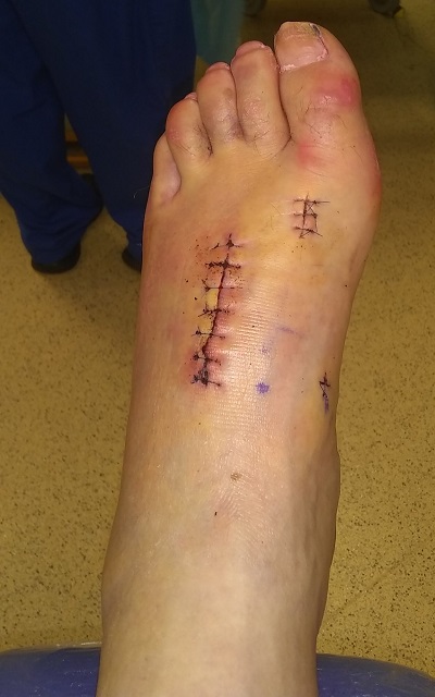 Garry Buchan's foot injury