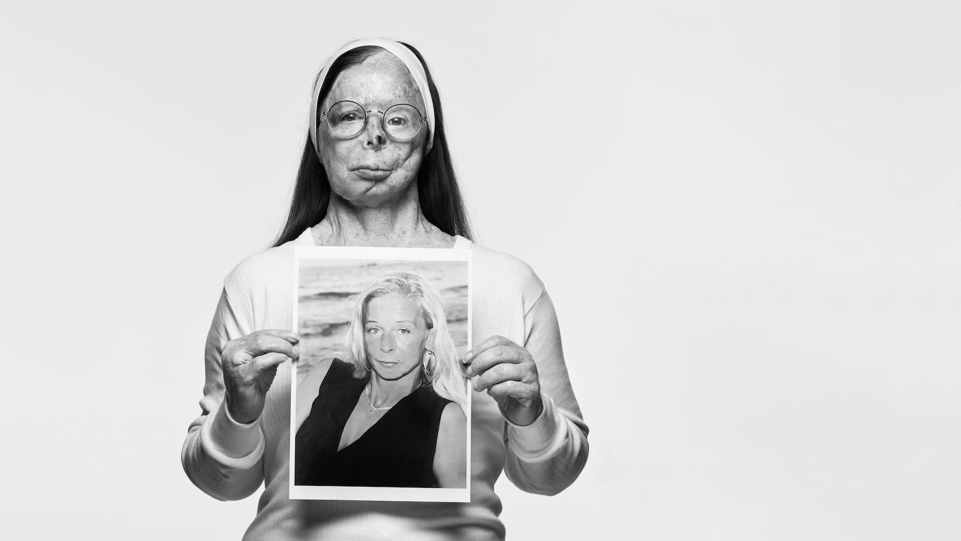 Acid attack survivor