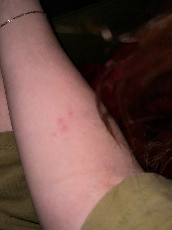 Alleged bed bug bites on an arm