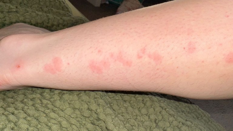 Alleged bed bug bites on an arm